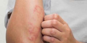 Laser Skin Rejuvenation