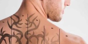 Tattoo Removal Treatment Service