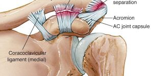 Arthritis and AC Joint Dislocation Treatment Surgery
