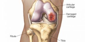 Cartilage Lesion Surgery