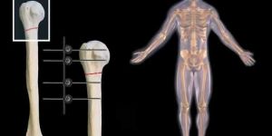 Fracture Fixtation Treatment