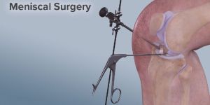 Meniscal Surgery