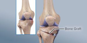 Osteoarthritis Treatment