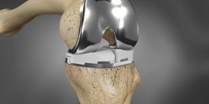 Partial Knee Replacement Surgery