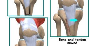 Patella Dislocation Treatment