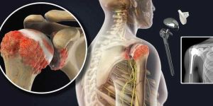 Best Shoulder Replacement Surgery in Bangalore
