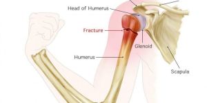 Shoulder Fractures Treatment