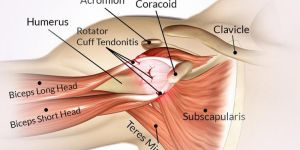 Shoulder Impingement Syndrome Surgery