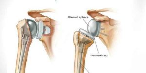 Shoulder Replacement Treatment Surgery