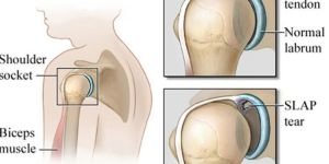 Slap Leisn Treatment Surgery