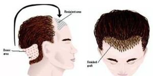 Mesotherapy Treatment