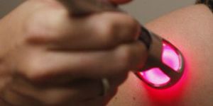 RF Microneedling Treatment