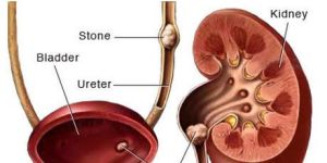 Kidney Stone Treatment