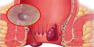 Piles And Fistula Treatment