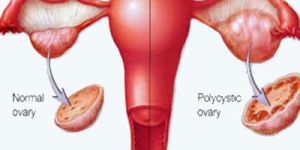 Polycystic Ovarian Syndrome Treatment
