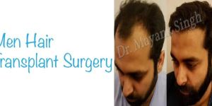 Mens Hair Transplant Services