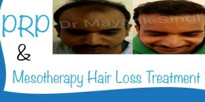 PRP & Mesotherapy Hair Loss Treatment Services