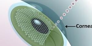 Bladeless LASIK in Mumbai