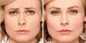 Blepharoplasty Treatment