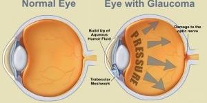 Glaucoma Treatment in Mumbai