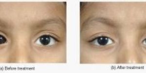 Paediatric Ophthalmology Treatment