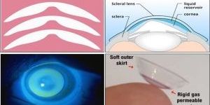 Pellucid Marginal Degeneration Treatment