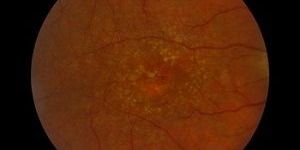 Retina Treatment in Mumbai