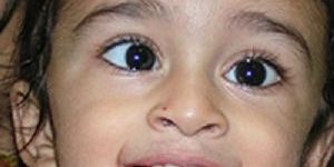 Squint Treatment in Mumbai