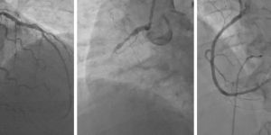 Coronary Angiogram in India