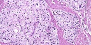 Glandular Cancer Treatment in India