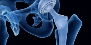 Hip Replacement Surgery in India