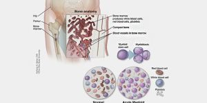 Leukemia Treatment in India