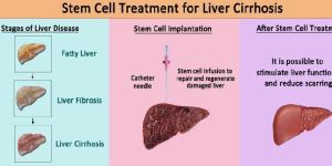 Liver Cirrhosis Treatment in India