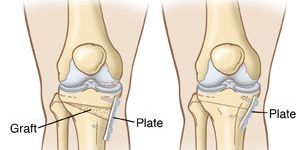 Osteotomy in India