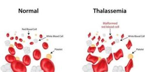 Thalassemia Treatment in India