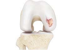 Knee Arthritis Treatment Services