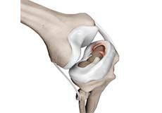 Meniscal Tear Treatment Services