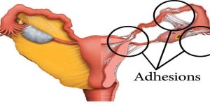 Ashermans Syndrome Treatment