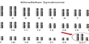 Klinefelter System Treatment