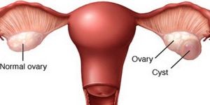 Ovarian Cyst Treatment