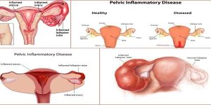 Pelvic Inflammatory Disease Treatment