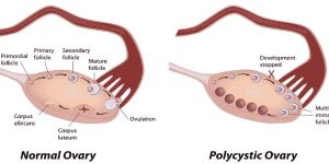 Polycystic Ovarian Disease Treatment