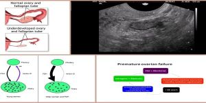 Premature Ovarian Failure Treatment