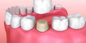 Dental Crown and Bridge Services
