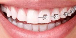 Orthodontic Treatment and Aligner Services