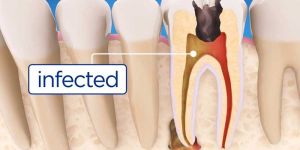 Root Canal Treatment Service