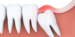 Wisdom Tooth Removal Service