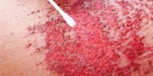 Major Skin Abrasions Stem Cell Treatment Services