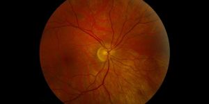 Optic Nerve Hypoplasia Stem Cell Treatment Services