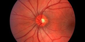 Optic Neuropathy Stem Cell Treatment Services